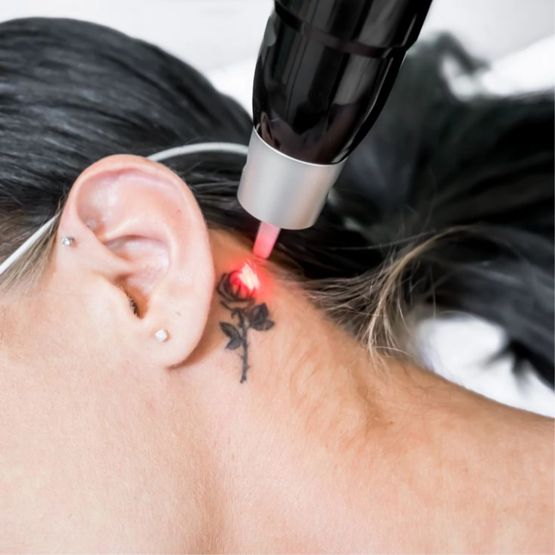 Laser Tattoo Removal