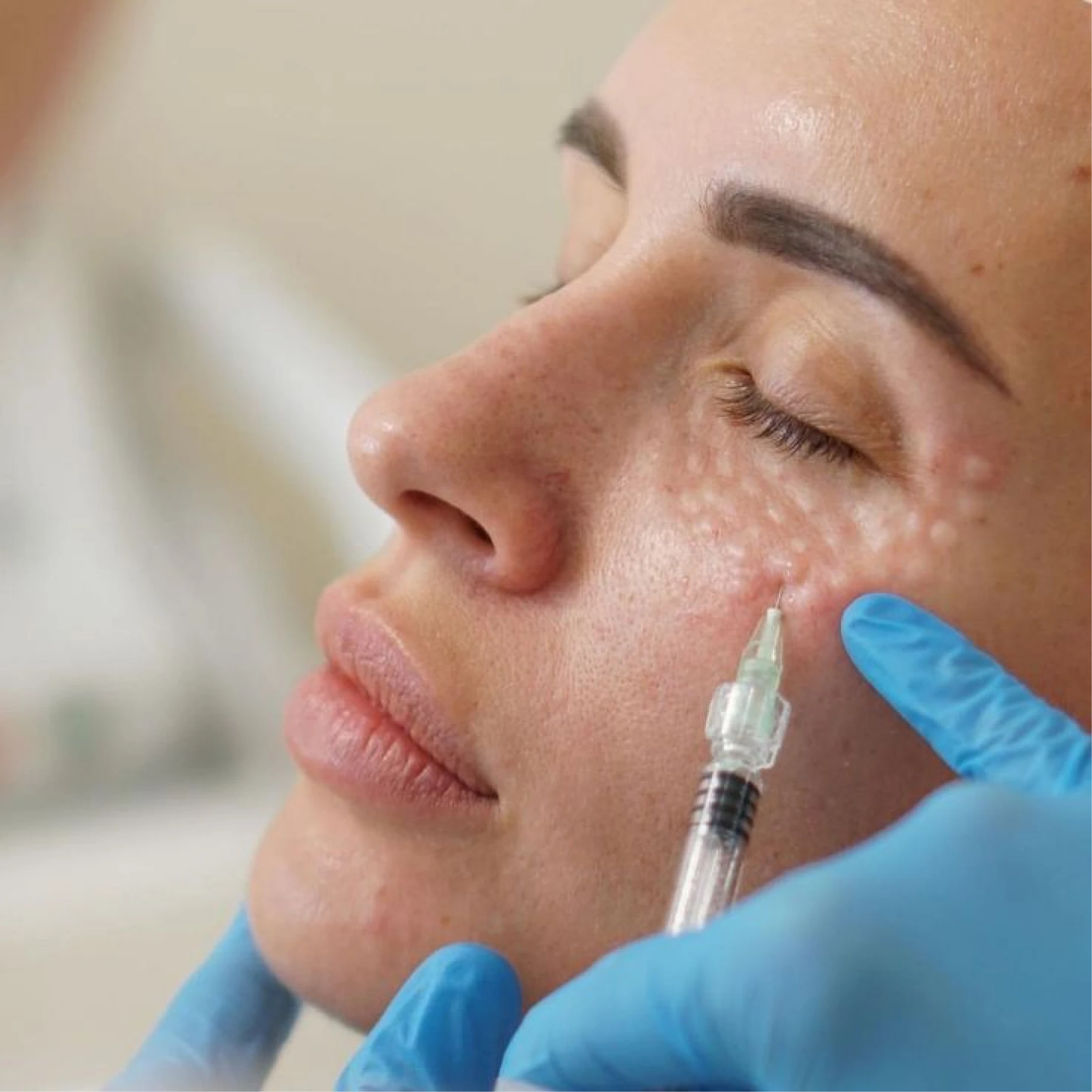 Mesotherapy - Cosmetology Treatment at Sattva Skin Clinic