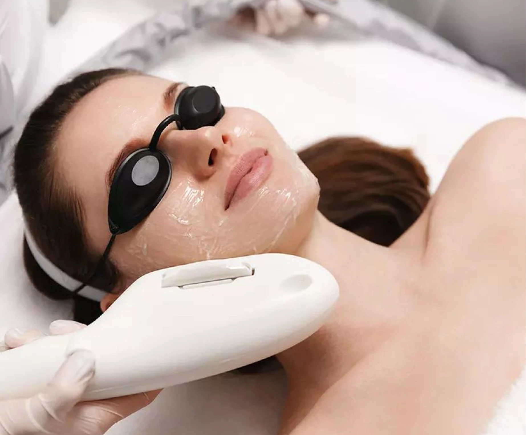 Photo Facial