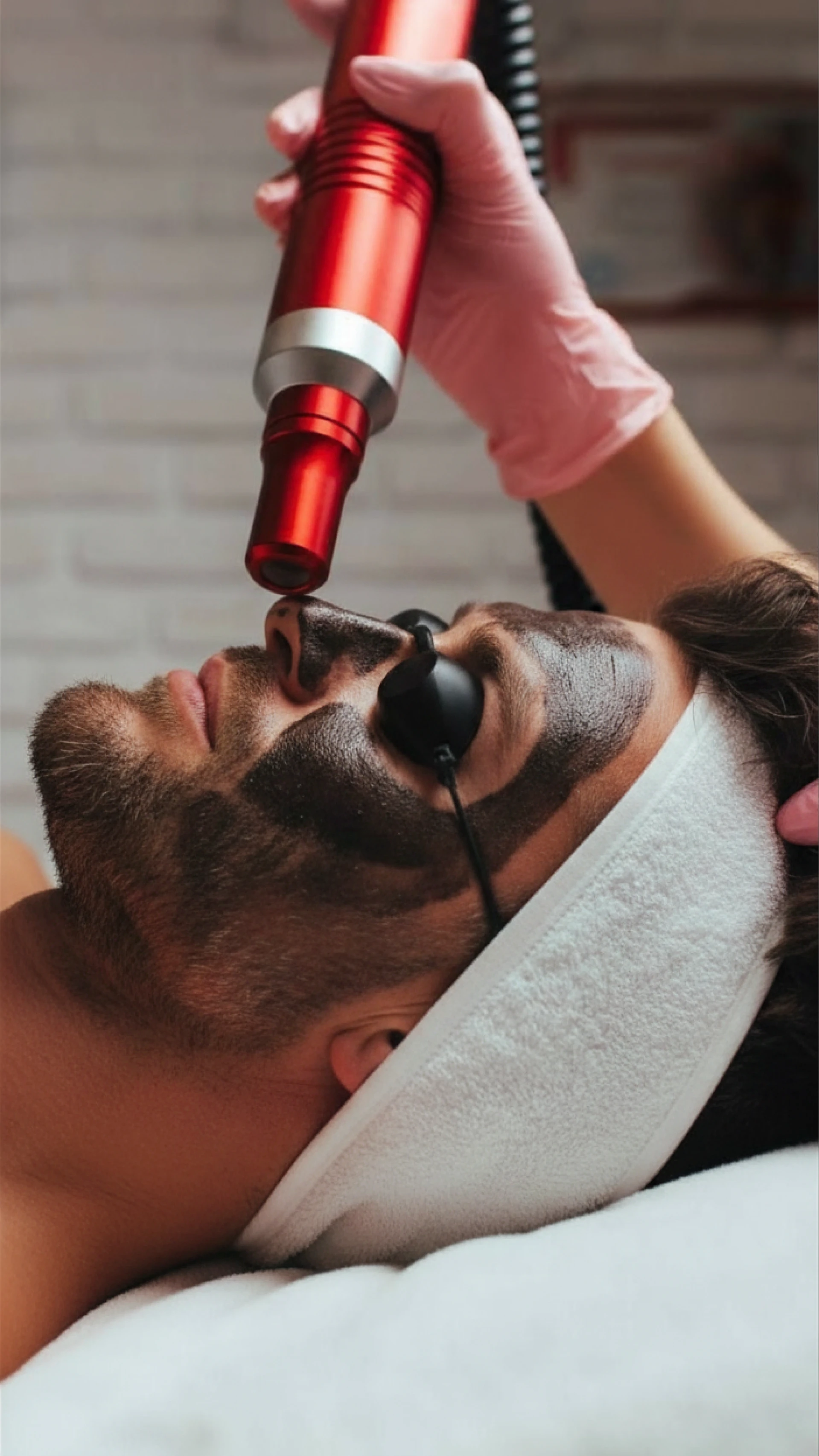 Q Switch Laser - Sattva Skin Clinic
