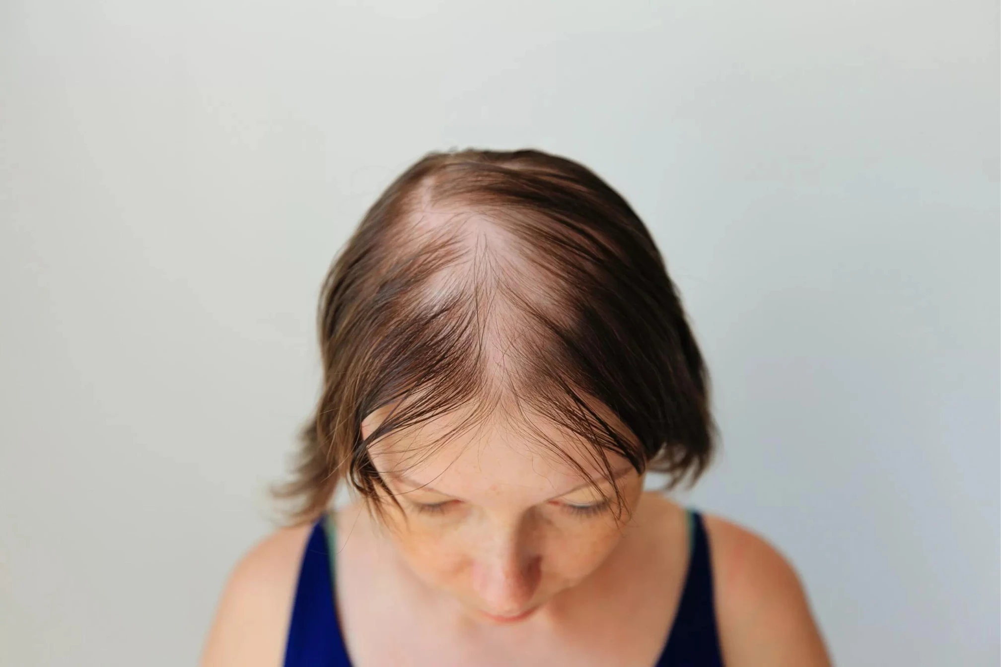 Hair Transplant - when this treatment is not recommended
