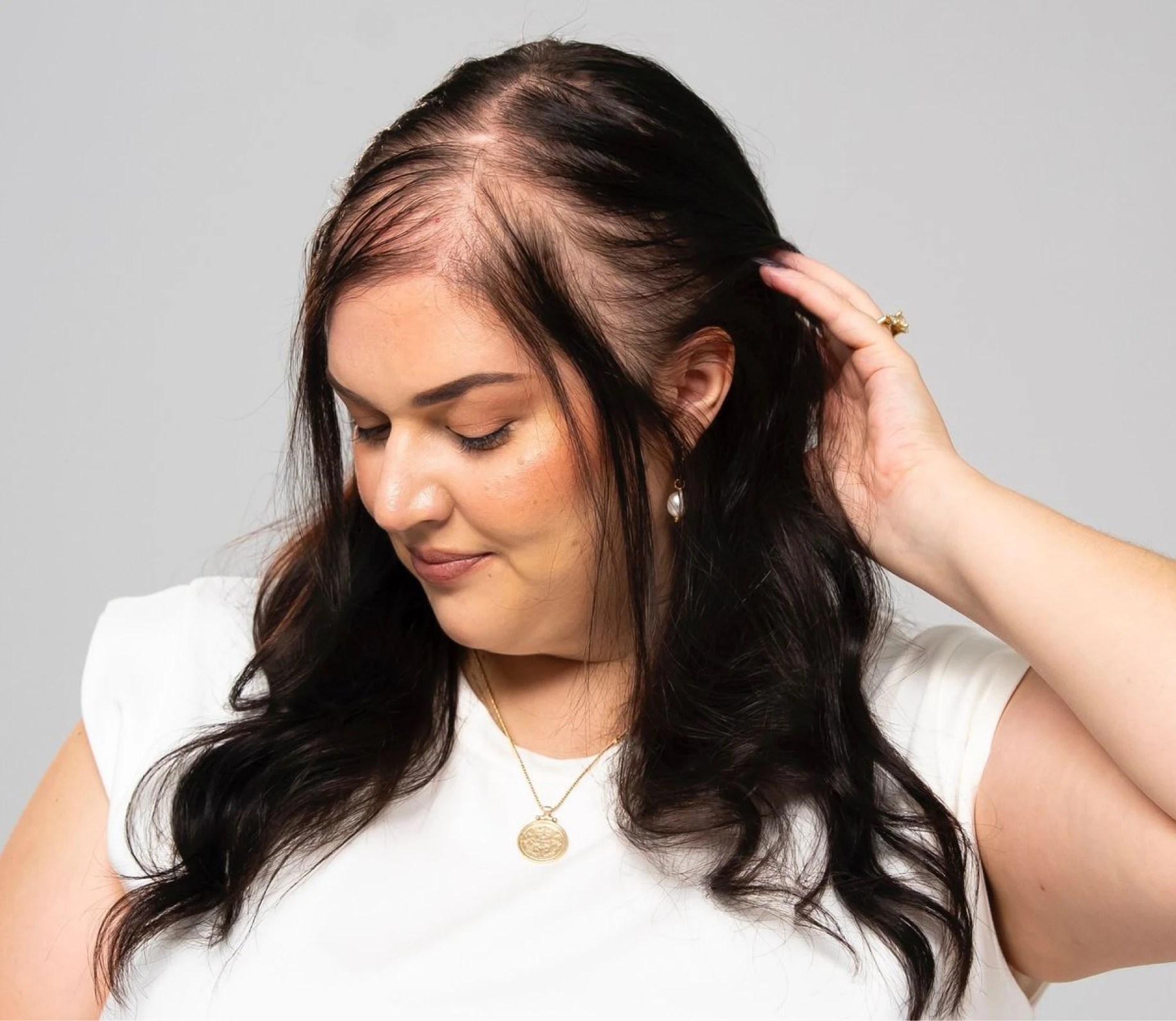 Who Hair Transplant is suitable for