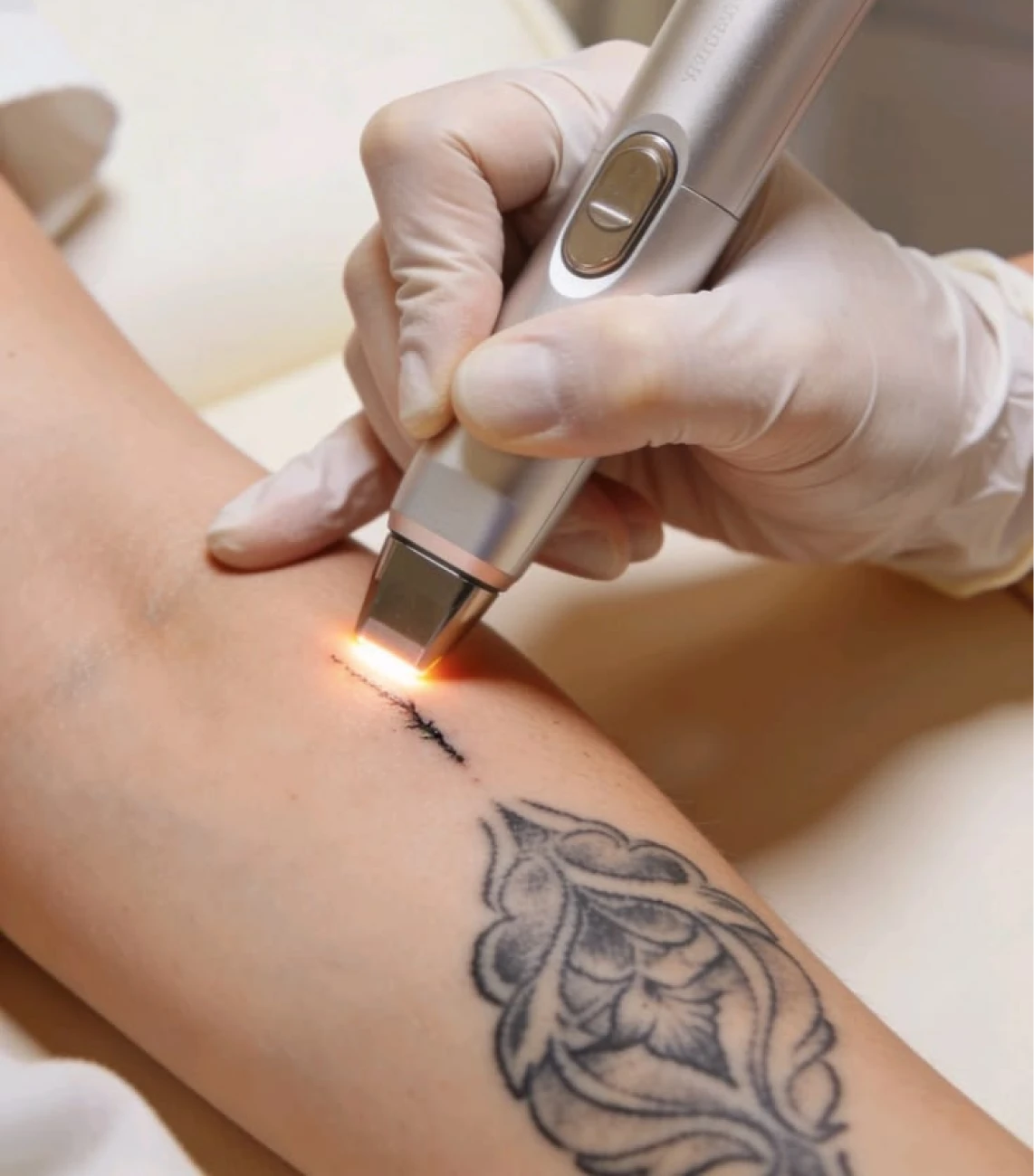 Step 3: Laser Application