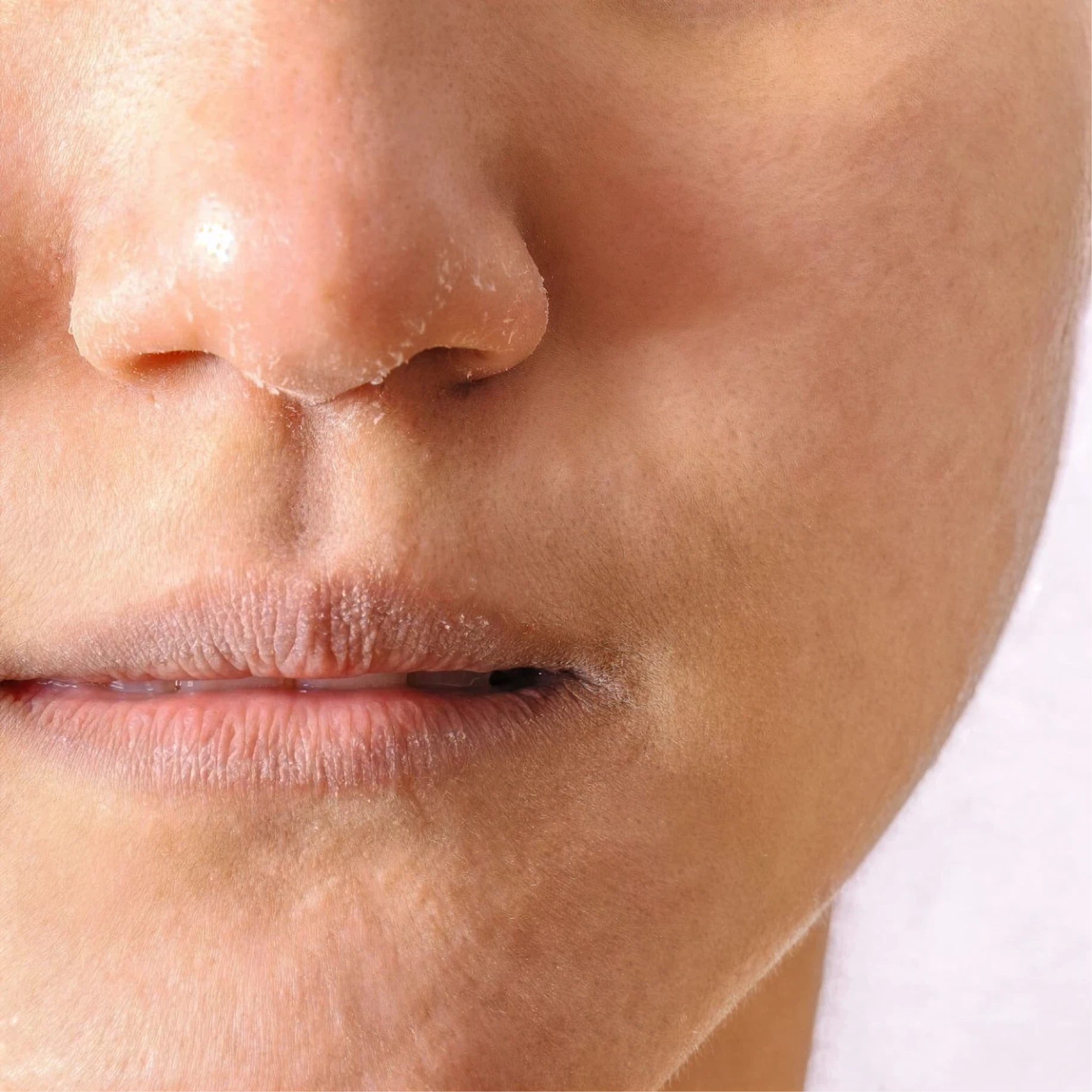 Who Mesotherapy is suitable for