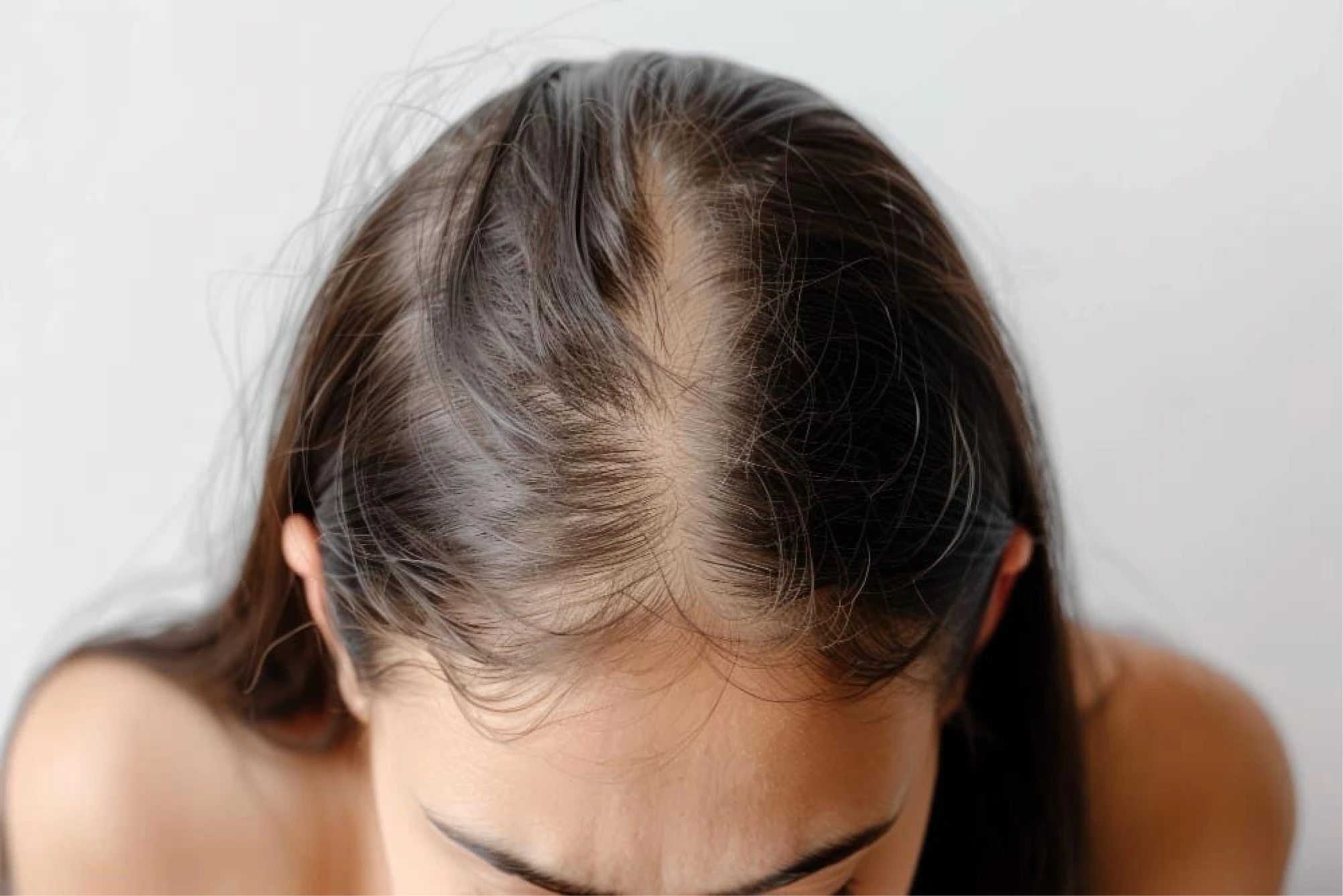 Who PRP for Hair is suitable for