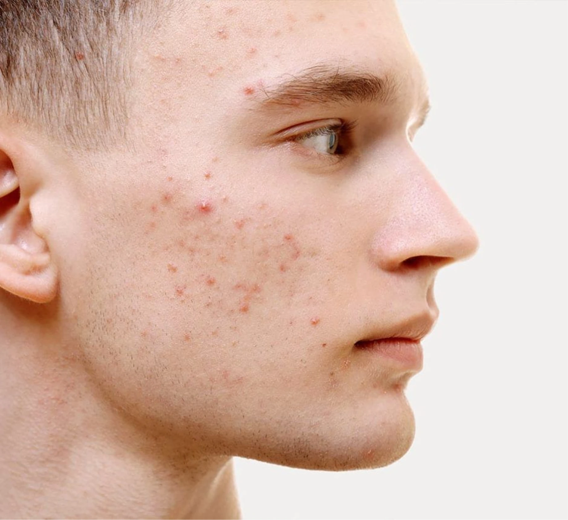 Who Carbon Facial is suitable for