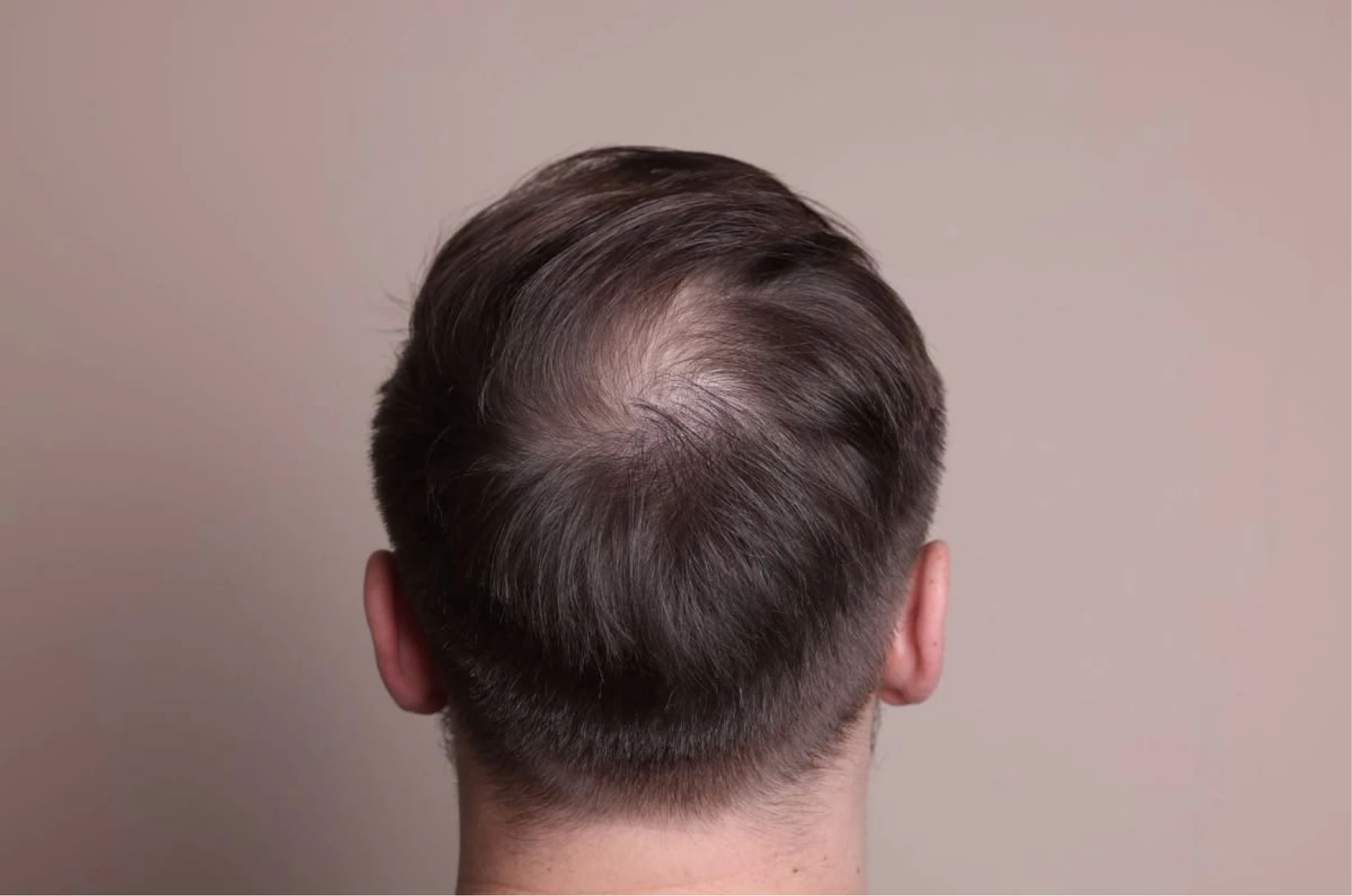 Who Mesotherapy for Hair is suitable for
