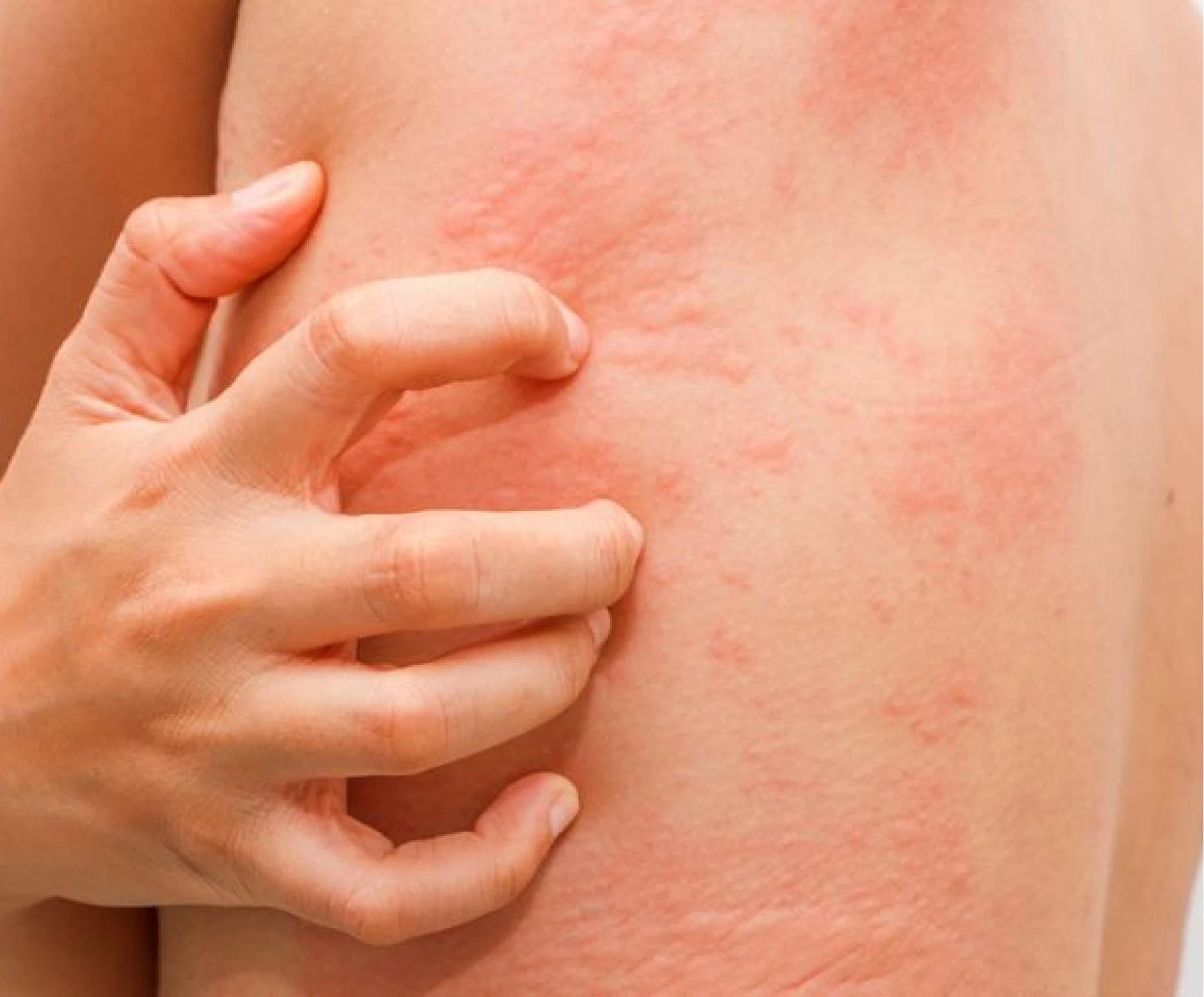 Eczema clinical illustration