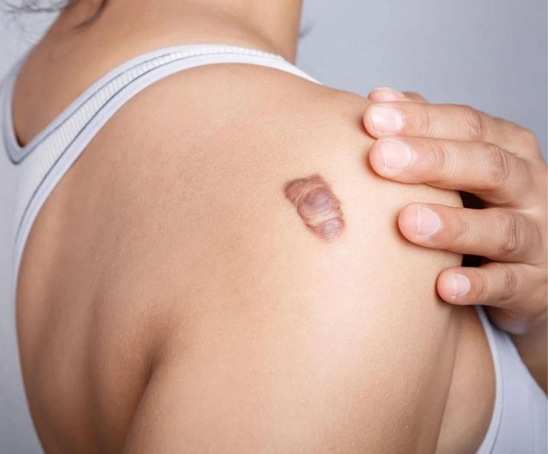 Keloid clinical illustration