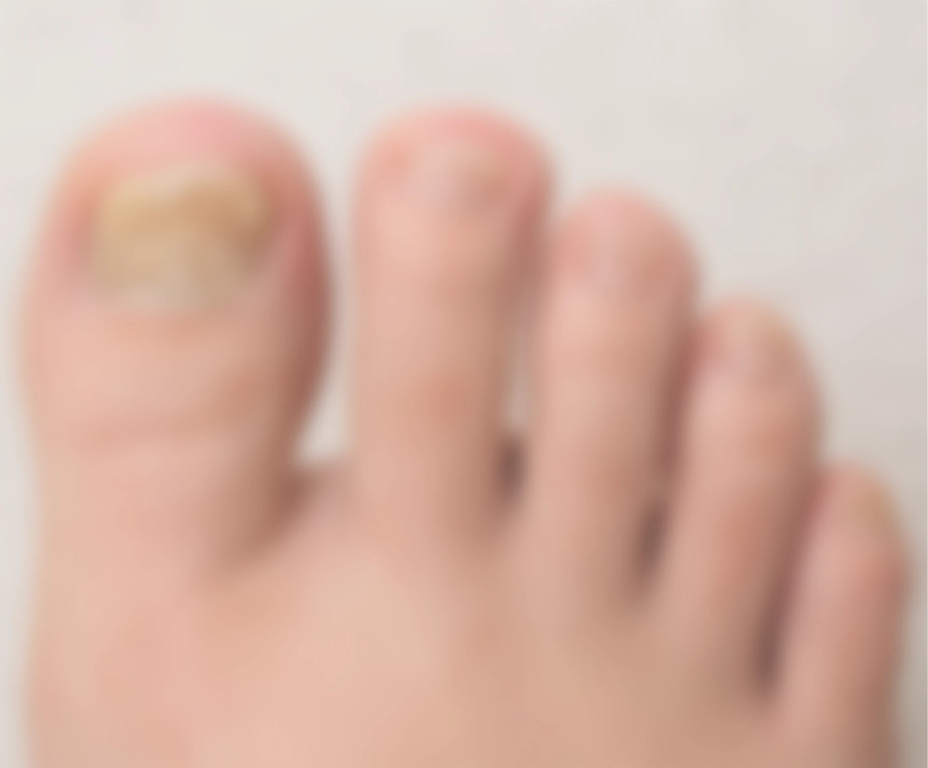 Nail Avulsion - Sattva Skin Clinic