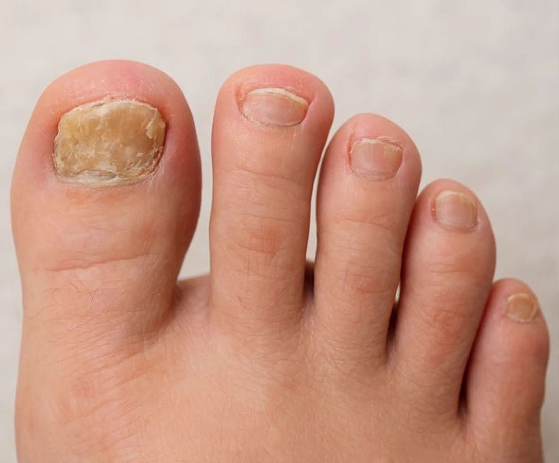 Nail Avulsion clinical illustration