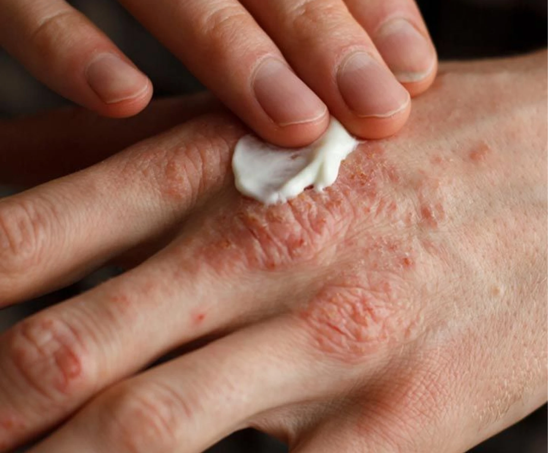 Psoriasis clinical illustration