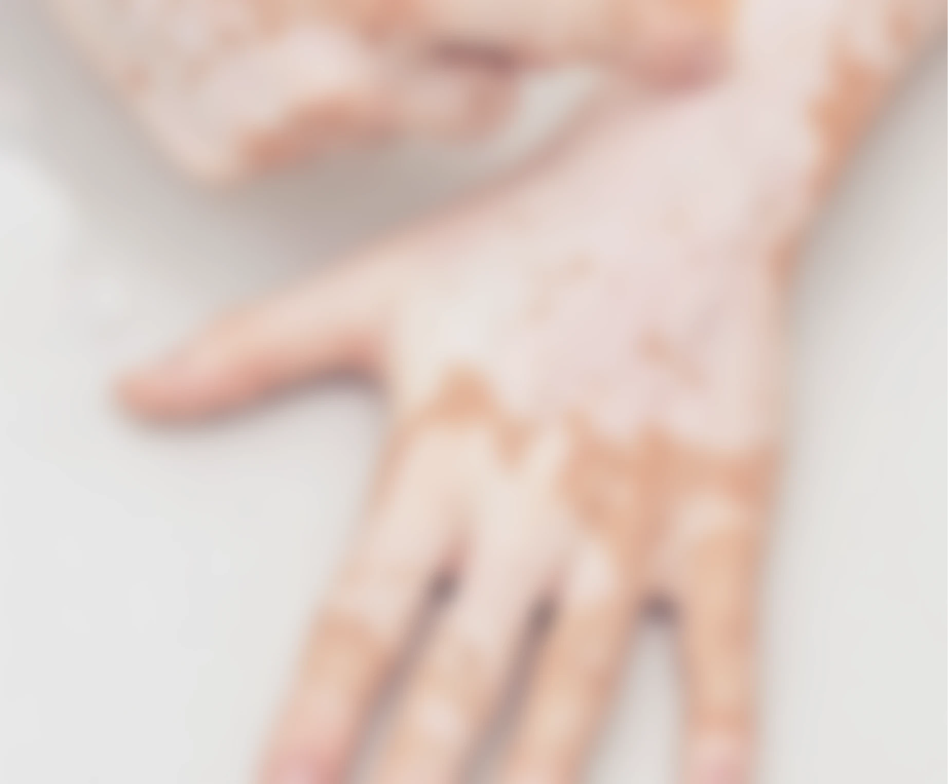 Vitiligo - Sattva Skin Clinic