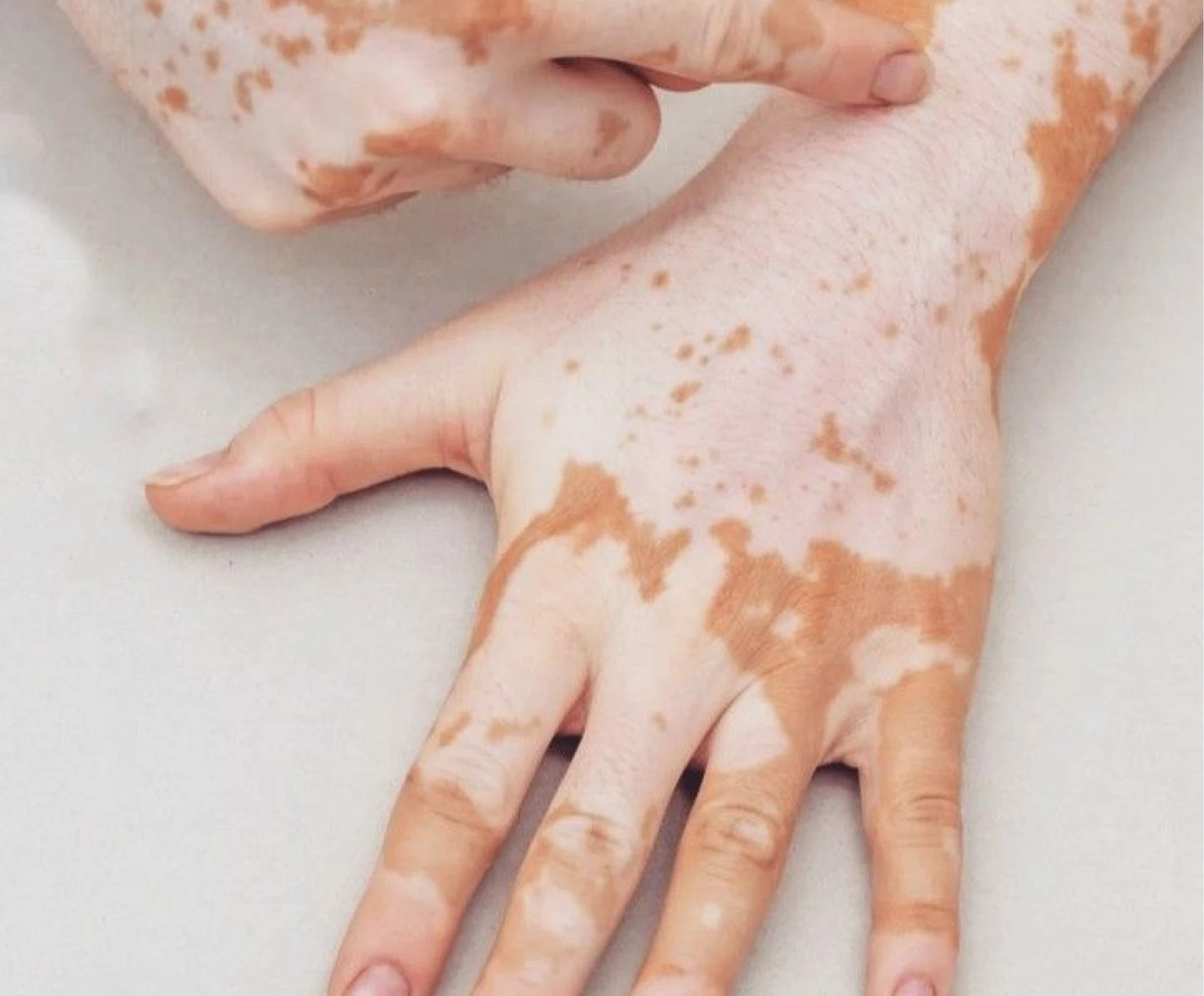 Vitiligo clinical illustration