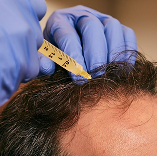 sattva skin clinic with advanced technology - reema kataria - PRP Therapy (For Hair) Image