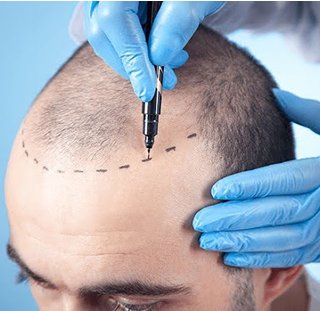 sattva skin clinic with advanced technology - reema kataria - Hair Transplant Image