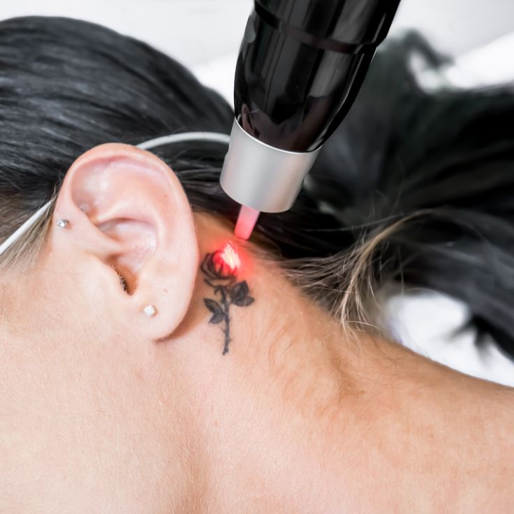 sattva skin clinic with advanced technology - reema kataria - Laser Tattoo Removal Image